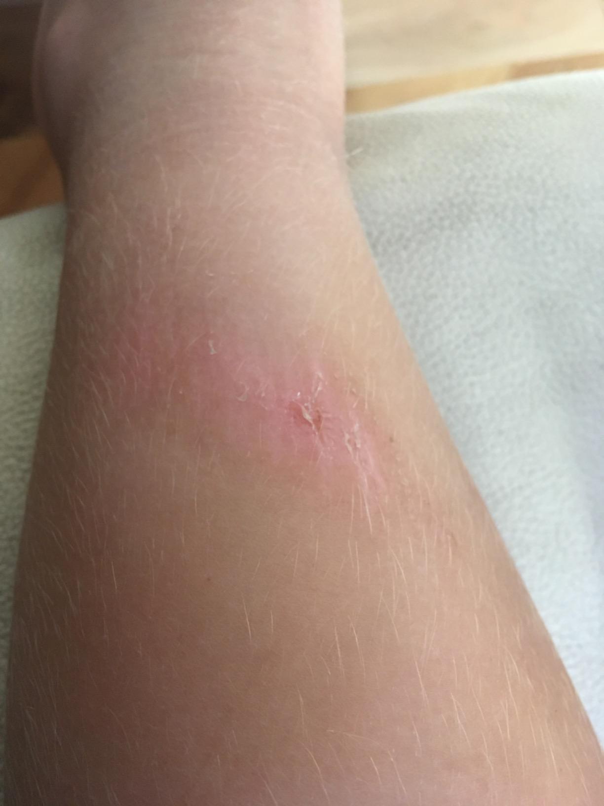 Ideale dopo il laser